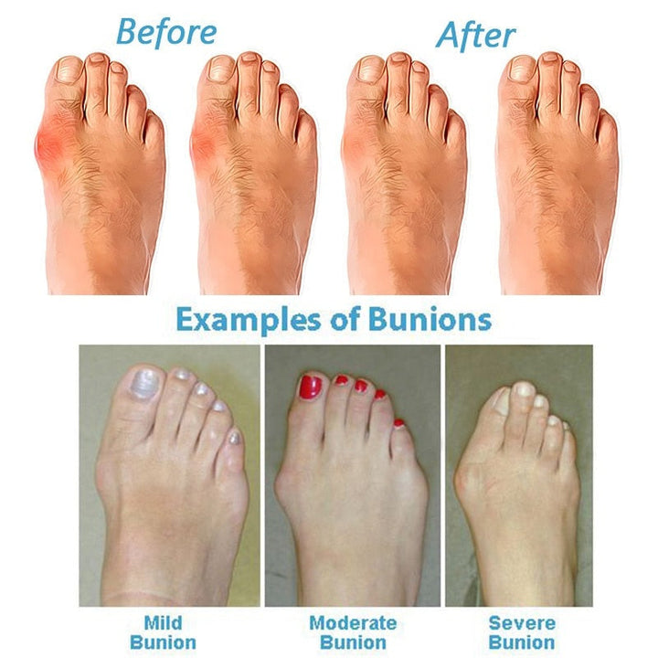 OrthoSole – Sandalen für Hallux Valgus mit Komfort und Unterstützung 7