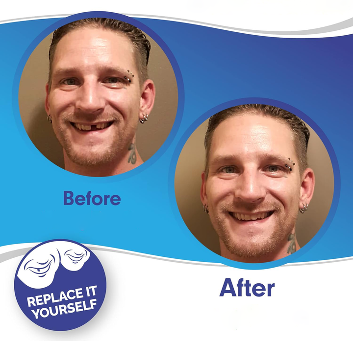 SmilePro Zahnveneers – Perfektes Lächeln für Zähne mit Veneers, FDA-zugelassen 1