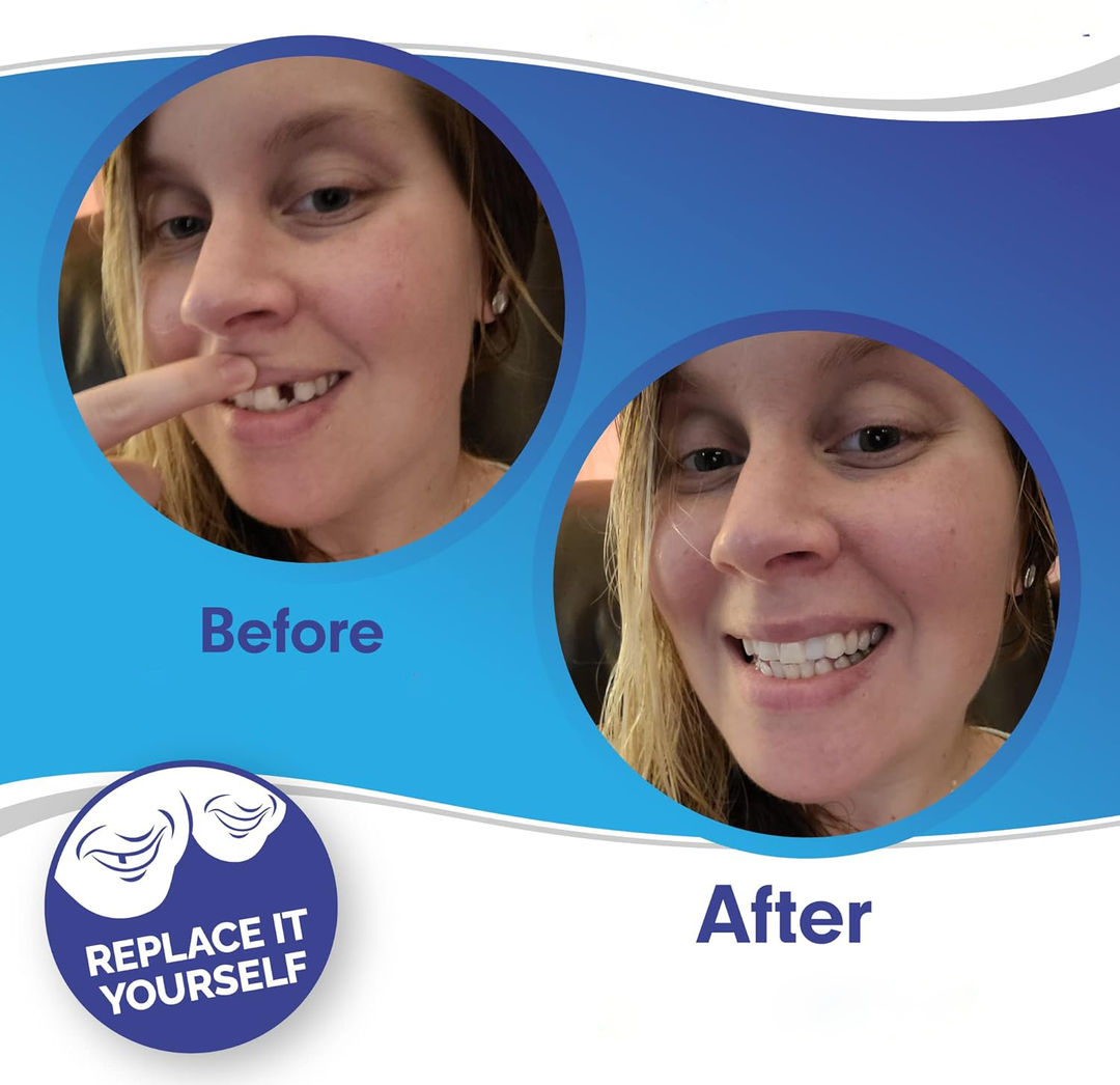 SmilePro Zahnveneers – Perfektes Lächeln für Zähne mit Veneers, FDA-zugelassen 2
