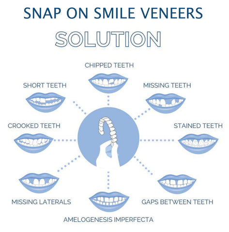 SmilePro Zahnveneers – Perfektes Lächeln für Zähne mit Veneers, FDA-zugelassen 5