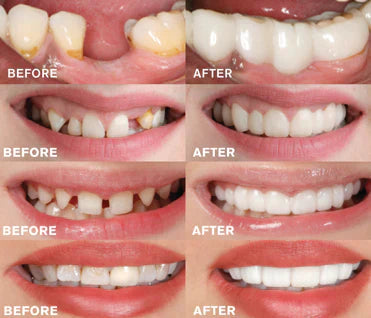 WhiteSmile – Sofort Zahnersatz Zahnprothese Für Strahlend Weiße Zähne 4